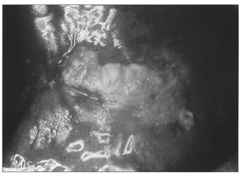 Chronic Hyperplastic Candidiasis Histology