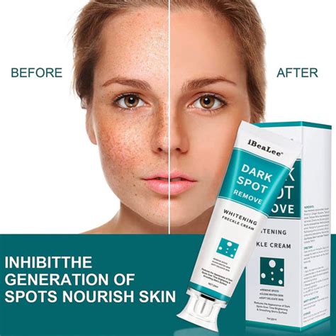 Freckle Removal Cream Effectively Remove Ac Ne Melasma Dark Spots