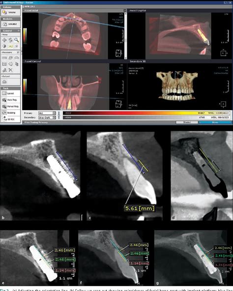 Immediate Implant Placement Utilizing Vestibular Socket 44 Off