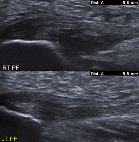 A Case Of Bilateral Baxter S Neuropathy Secondary To Plantar Fasciitis The Journal Of Foot And