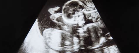 Doctors Report World’s Second Case of “Semi-Identical” Twins - Israel ...