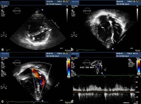 A Year Old Male With D Tga Post Atrial Switch Operation A