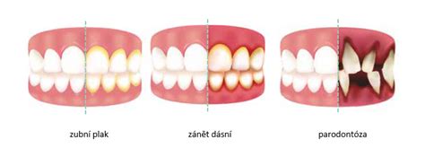 Zánět dásní a parodontóza Empolas zdravi cz