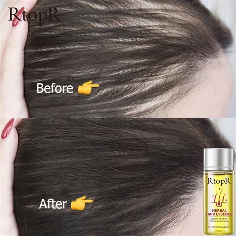 Rtopr Fda Hair Growth Essence Anti Hair Loss Liquid Promote Thick Fast Hair Growth Treatment