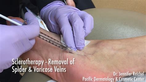 Varicose And Spider Vein Treatment Sclerotherapy Demo By Dr Jennifer