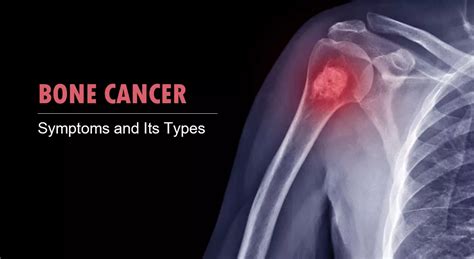 Bone Cancer Symptoms and Types