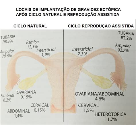 Gesta O Ect Pica Dr Eduardo Dale Ginecologia E Reprodu O Humana