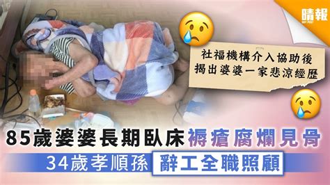 【家庭悲歌】85歲婆婆長期臥床褥瘡腐爛見骨 34歲孝順孫辭工全職照顧 晴報 健康 老人病 D201110