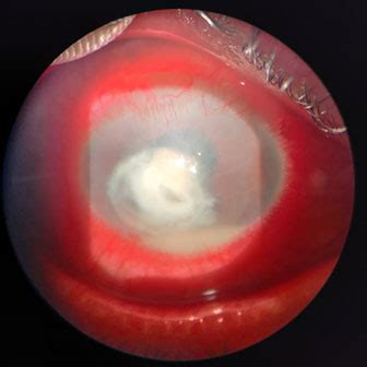 Corneal-infections-Red-congested-eye-with-yellowish-lesion-on-the ...