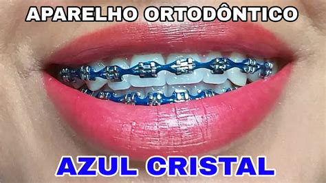 Aparelho Ortod Ntico Cor Azul Cristal Youtube