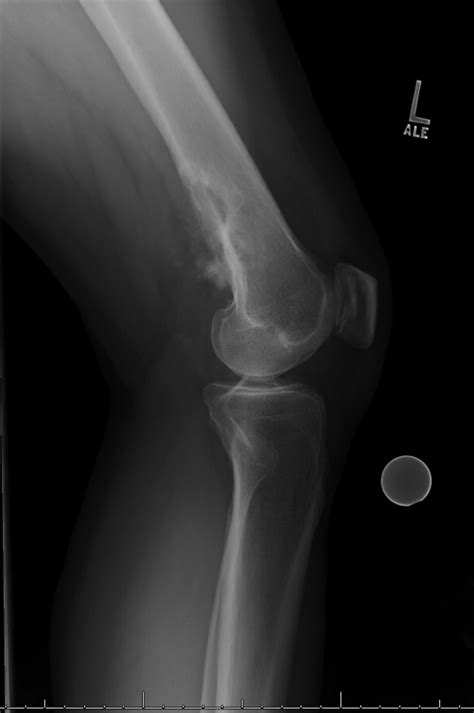 Malignant Bone And Soft Tissue Lesions Radiology Case Collection