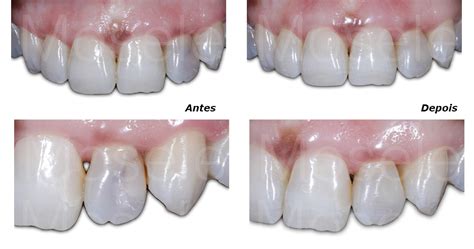 Les Es De C Rie Dentes Anteriores Dentista Em Passo Fundo