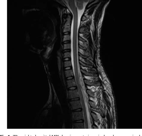 Figure 1 From Pontaneous Epidural Hematoma Due To Cervico Thoracic