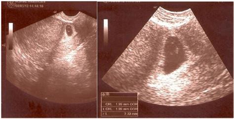 Transvaginal Sonogram Of A Patient With Type 2 Cesarean Scar Pregnancy