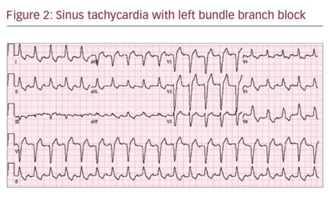 Intermittent Left Bundle Branch Block A Challenging Case Of Rare