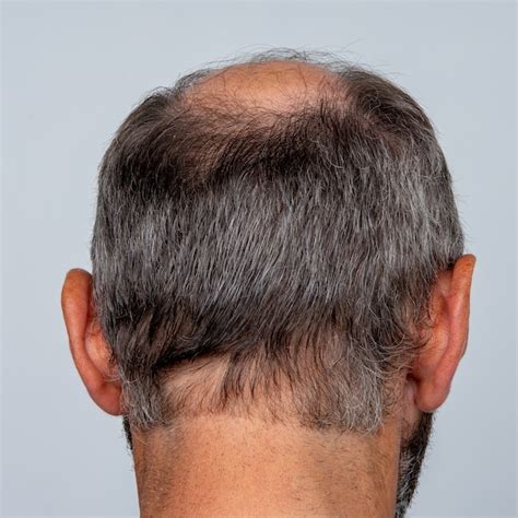 Premium Photo | A closeup of a half-bald male head, hair transplant ...