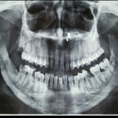 (left) X-ray OPG showing short ramus height, prominent antegonial notch ...