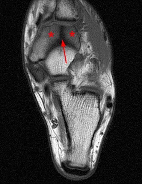 Metatarsal Stress Fracture Mri