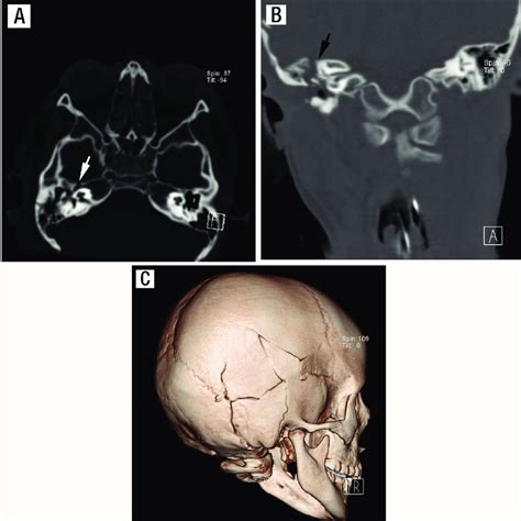 A Axial Computed Tomography Scan Showing An Oblique Fracture Of The