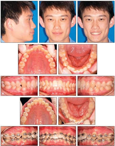 Creative Adjuncts For Clear Aligners Part 1 Class Ii Treatment Jco Online Journal Of