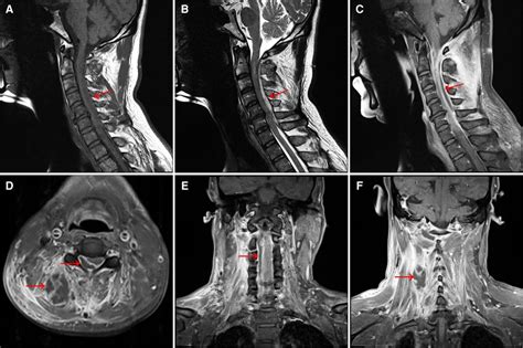 Frontiers Case Report A Case Of Cervical Spinal Epidural Abscess