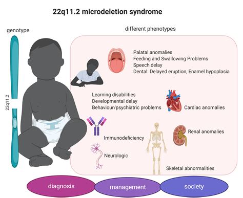 Genes Free Full Text Consequences Of 22q112 Microdeletion On The