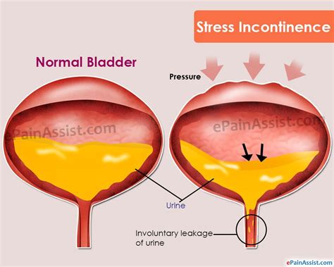 Stress Incontinence Stress Incontinence Stress Symptoms Male