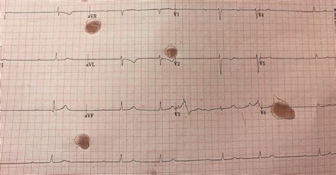 Dr Smith S ECG Blog Syncope And Chest Pressure Then An Unusual