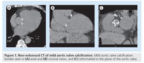 Aortic valve calcification using multislice CT