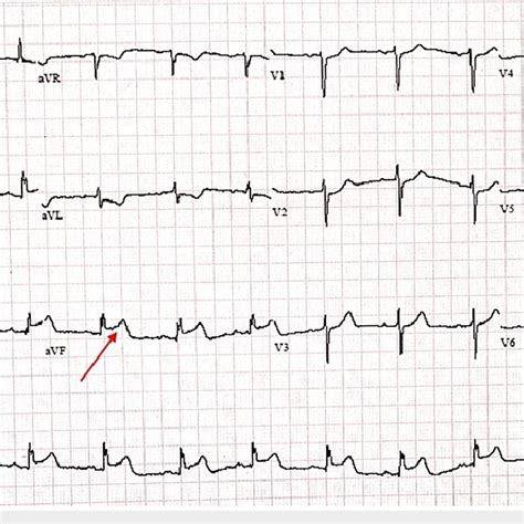 ECG Demonstrate Inferior Wall ST Elevation Myocardial Infarction