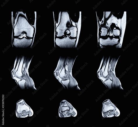 Magnetic resonance imaging (MRI) of right knee. Closed injury of the ...