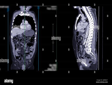 Acquisition Ct Du Thorax Et De L Abdomen Vue Coronale Et Sagittale Avec