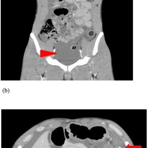 Ab Preoperative Enhanced Abdominal Computed Tomography Scan A Diffuse Download Scientific