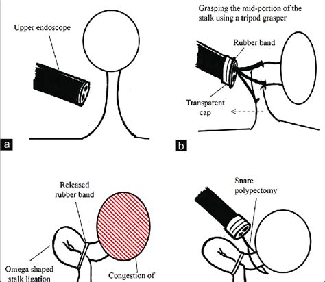 Schematic Showing The Endoscopic Band Ligation Associated Colonic