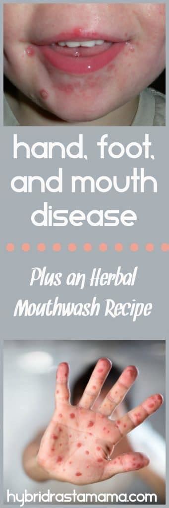 Herbs and Children – Hand, Foot, and Mouth Disease (Plus An Herbal Mouthwash Recipe) | Hybrid ...