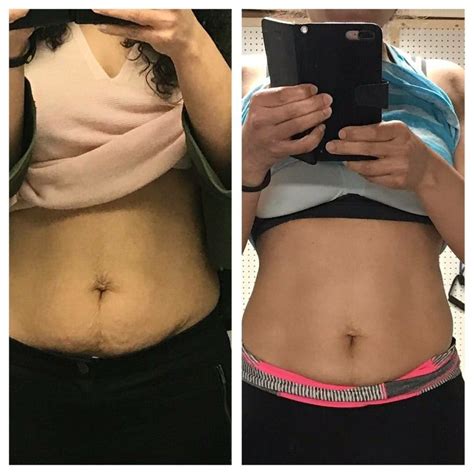 Before And After Pictures Of Stomach Area From Using Tummy Tuck Cream