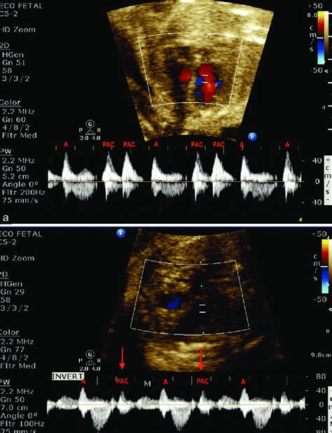 Blocked atrial bigeminy frequently has a variable atrial rhythm, with a ...