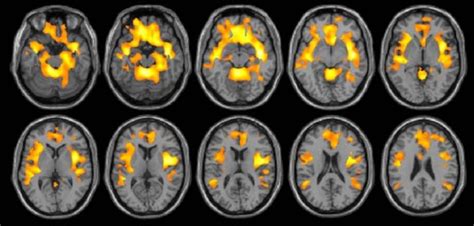 Substance abuse reduces brain volume in women but not men