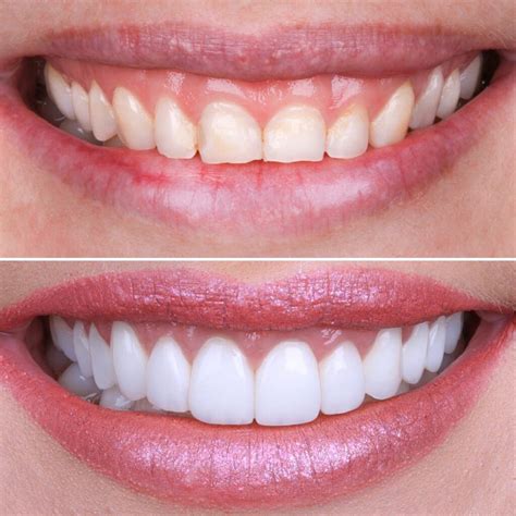 Emax Veneers In Turkey Can Be Completed In 5 Days