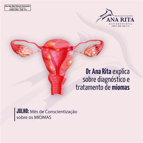 Dr Ana Rita explica sobre diagnóstico e tratamento de miomas Ana Rita