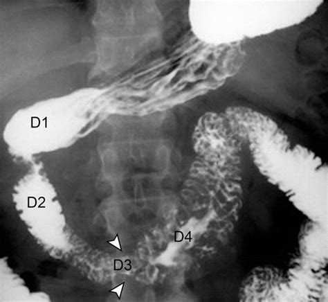 Fluoroscopic Evaluation Of Duodenal Diseases Radiographics