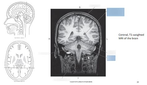 Coronal T1 Brain Mri Terms And Definitions For Biology Flashcards Quizlet