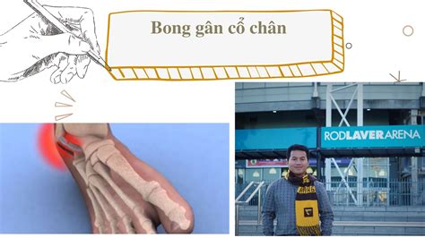 Bong Gân Cổ Chân điều Trị Sao Cho đúng Tránh đau Dai Dẳng Về Sau Dr Bone