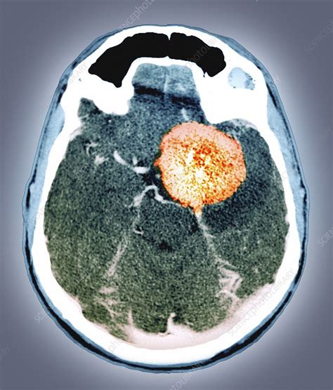 Brain Tumour CT Scan Stock Image C026 9955 Science Photo Library