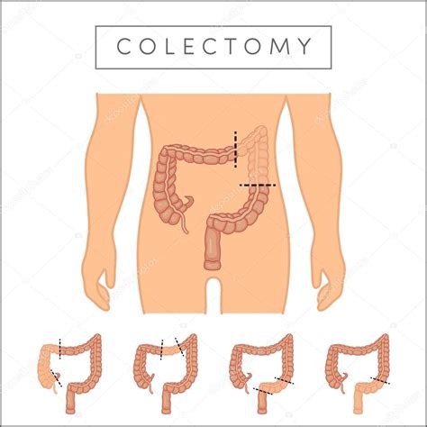 Illustration types of colectomy — Stock Vector © marina_ua #105380118