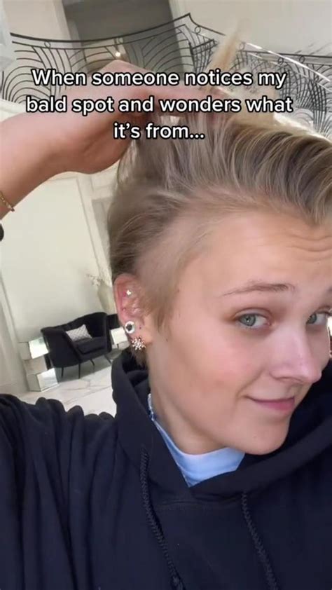 Jojo Siwa Reveals Bald Patch From Dance Moms Stress