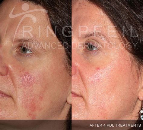 Rosacea Laser Treatment