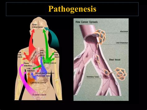 Metastatic Tumors Of Jaws PPT