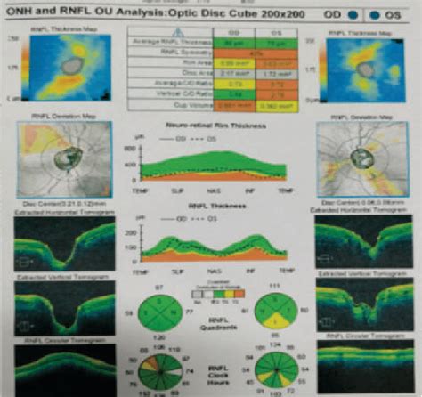 OCT Optic nerve head(ONH) and RNFL showing nerve fibre layer thinning ...