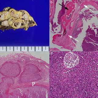 A Gross Appearance Of The Tumor The Resected Tumor Appeared To Be A